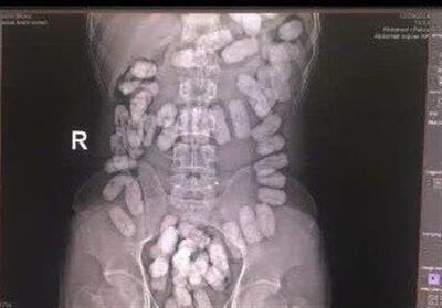  کشف 48 بسته مواد مخدر از معده یک تبعه افغانستانی در تایباد - تسنیم