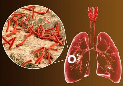 ابتلای ۶ هزار ایرانی به یک بیماری خطرناک ریوی | ۸ استان در صدر شیوع بیماری