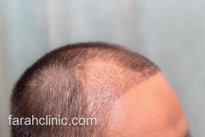  زیبایی دوباره با تکنولوژی جدید کاشت مو؛ بدون نیاز به جراحی