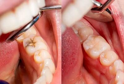  پر کردن دندان با کامپوزیت بهتر است یا مواد سیاه؟