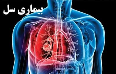  ۶۵۶۵ مبتلا به «سل» در کشور شناسایی شدند