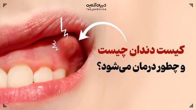  کیست دندان؛ از انواع تا درمان