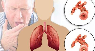  ابتلای ۱۰ میلیون ایرانی به آسم و انسداد ریوی | جهان نیوز