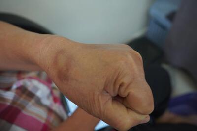  چرا بدن سالمندان دچار کبودی بی دلیل و ناگهانی می شود ؟