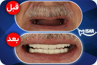 قطعنامه 2231 چیست ؟ / این قطعنامه سازمان ملل برای ایران چه سودی دارد؟