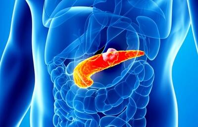  برداشتن کیسه صفرا تنها راه خلاصی از سنگ‌های صفراوی است؟