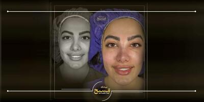  قبل از عمل بینی این ۷ نکته را حتما بخوانید!