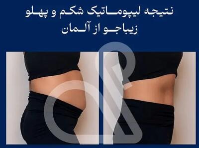  چه کسانی می توانند از روش لیپوماتیک 360 درجه استفاده کنند؟