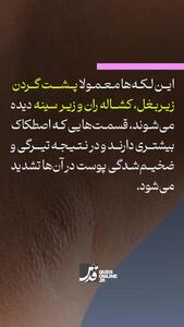  این علامت در پوست نشانه قند خون بالاست+فیلم