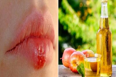  از بین بردن تبخال در کمترین زمان و تو خونه با استفاده از این ژل؛ التهاب رو نابود کن