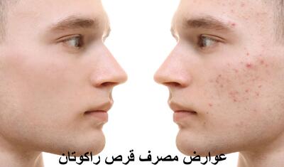 عوارض مصرف قرص راکوتان برای جوش در زنان و مردان چیست؟