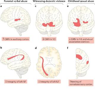 تأثیر تروماهای کودکی بر مغز بالغ؛ زخم‌هایی که در MRI هم دیده می‌شوند