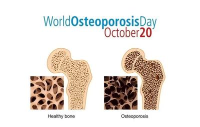  ۲۰ اکتبر روز جهانی پوکی استخوان است