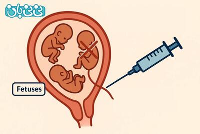  ریداکت جنین یا حذف جنین در بارداری‌های چند قلویی + ۵ خطر آن