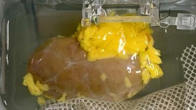  ساخت «کلیه جهانی» سازگار با هر گروه خونی