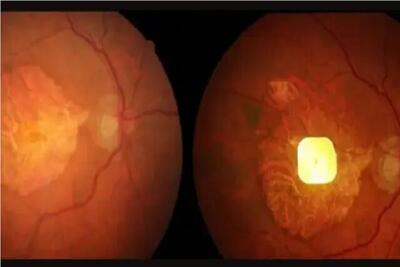  نابینایان با این ایمپلنت دوباره می‌توانند بخوانند