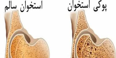 رتبه بیستم ایران در پوکی استخوان در دنیا؛ روزانه ۴۱۰ شکستگی ناشی از پوکی استخوان در روز گزارش می‌شود/ از هر ده نفر بالای 50 سال دو نفر تراکم طبیعی دارند