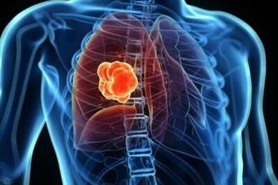  فقط سیگاری‌ها به سرطان ریه مبتلا می‌شوند؟