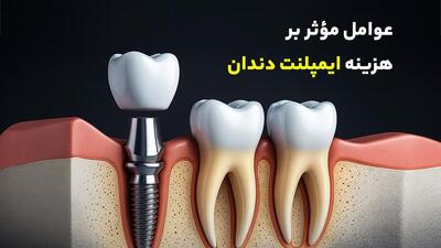  عوامل مؤثر بر هزینه ایمپلنت دندان / راهکارهای کاهش مخارج در شیراز