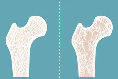  از هر ده نفر ایرانی بالای ۵۰ سال دو نفر تراکم طبیعی استخوان دارند!