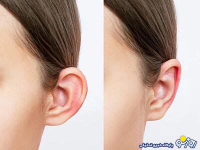  عمل اتوپلاستی چیست و چه کسانی نیاز به آن دارند؟