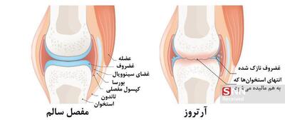  پیاده‌روی، دوچرخه‌سواری و شنا راه موثر مقابله با آرتروز