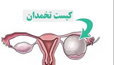 کیست تخمدان؛ مشکل شایع اما اغلب بی‌خطر در زنان