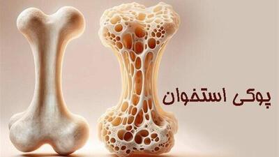  بیماری خاموشی که بی‌صدا استخوان‌ها را می شکند