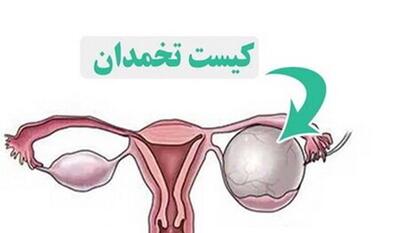  کیست تخمدان؛ مشکل شایع اما اغلب بی‌خطر در زنان