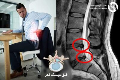  چگونه از دیسک کمر در کار اداری جلوگیری کنیم؟ علائم پنهان و پیشگیری مؤثر