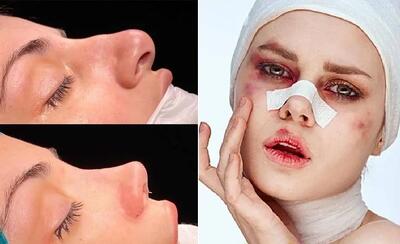  7 توصیه قبل و بعد عمل بینی / مبارکه خوشگل میشی اما بدون رعایت این نکات نتیجه عکسه
