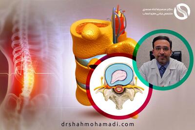  بهترین روش درمان دیسک کمر توسط دکتر شاه محمدی (متخصص دیسک کمر در تهران)