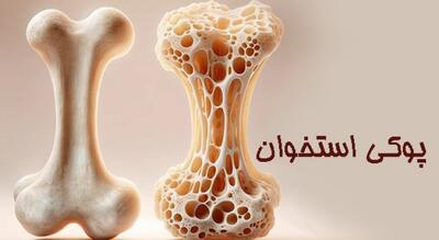  عوامل موثر بر پوکی استخوان و راهکارهای مقابله با آن