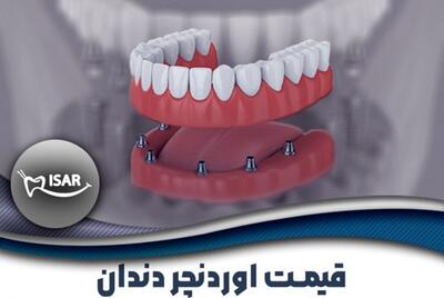 قیمت اوردنچر دندان در سال ۱۴۰۴ | معرفی کامل + جدول قیمت