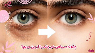  چگونه سیاهی دور چشم را از بین ببریم؟
