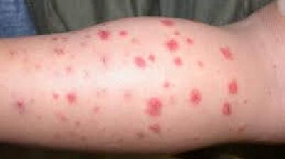  میگنا - بیمارِی هنوخ چیست؟