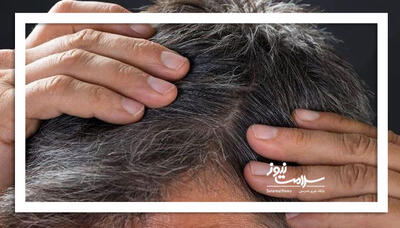  ارتباط میان سفیدی مو و سرطان ملانوما