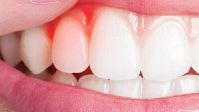  کیفیت پایین خواب، رهاورد بیماری‌های لثه