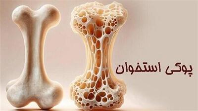  پوکی استخوان؛ تشخیص و درمان به‌ موقع