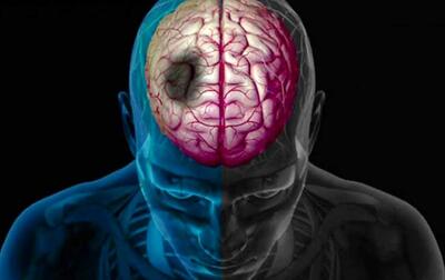 روزانه ۲۰۰ تهرانی دچار سکته مغزی می‌شوند!