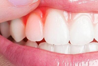  کیفیت پایین خواب، رهاورد بیماری‌های لثه