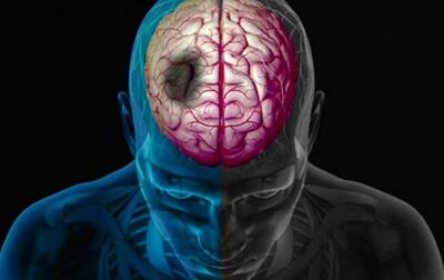 روزانه ۲۰۰ تهرانی دچار سکته مغزی می‌شوند!