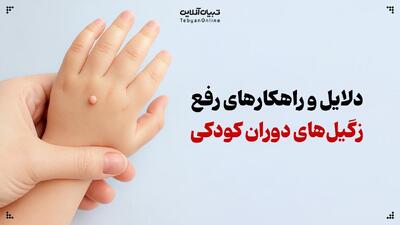  زگیل‌های دوران کودکی: چرا ایجاد می‌شوند و چه باید کرد؟