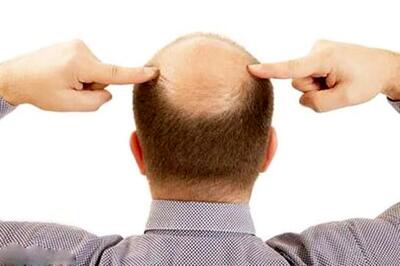  خبر خوب برای کسانی که طاسی دارند