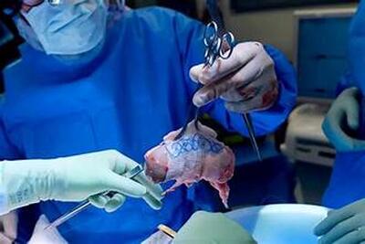  رکورد زنده ماندن با کلیه خوک شکست