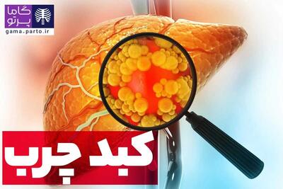  بیماری کبد چرب چیست؟ اینها علائم کبد چرب هستند به شدت مراقب باشید!