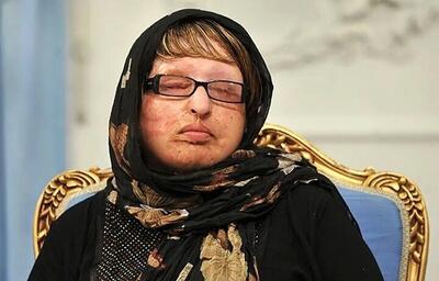  ‌حضور آمنه بهرامی، قربانی اسیدپاشی در دادسرای جنایی تهران