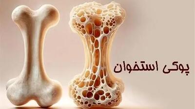  پوکی استخوان؛ تشخیص و درمان به‌ موقع