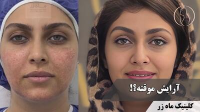 ⁨ می‌شه جای جوش کمتر شه؟ ( کلینیک زیبایی ماه زر )