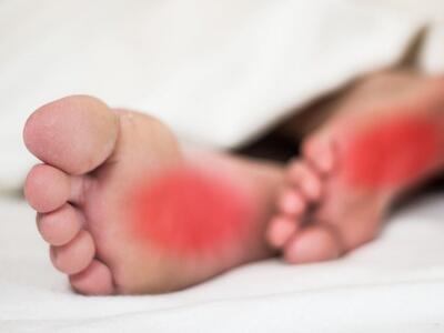  سندرم پای سوزان چیست و چرا در شب تشدید می‌شود؟